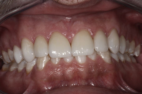 
  Veneers nach erfolgreicher Behandlung