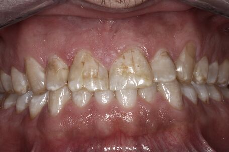 
  Zähne mit Verfärbungen und Unebenheiten vor der Behandlung, ohne Veneers